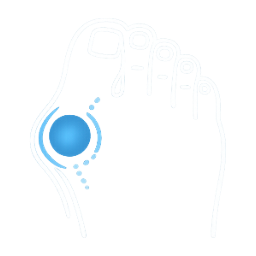Illustration of a bunion bump at the base of the big toe