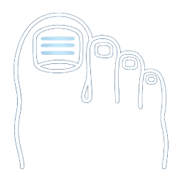 Illustration of a thickened, discolored fungal toenail