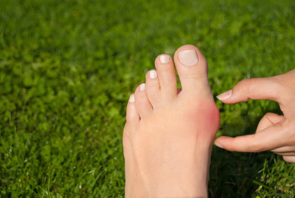 No-hardware bunion surgery patient care in San Diego